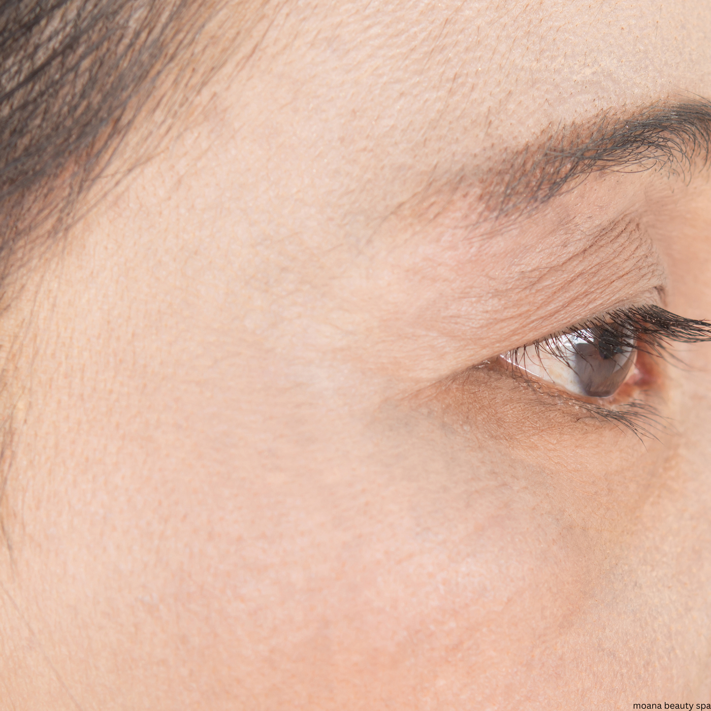 Eye Area Appearance — after
