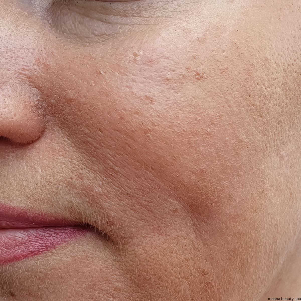 Lumen LED Radiance Therapy — Before