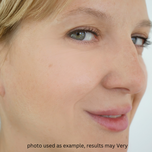 Eneo Non-Surgical Facelift — After