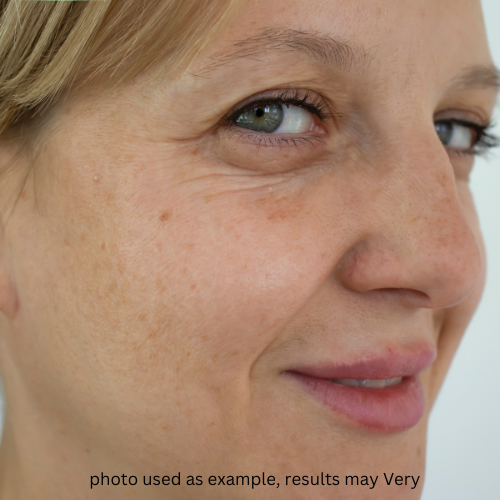 Wrinkle Appearance — before