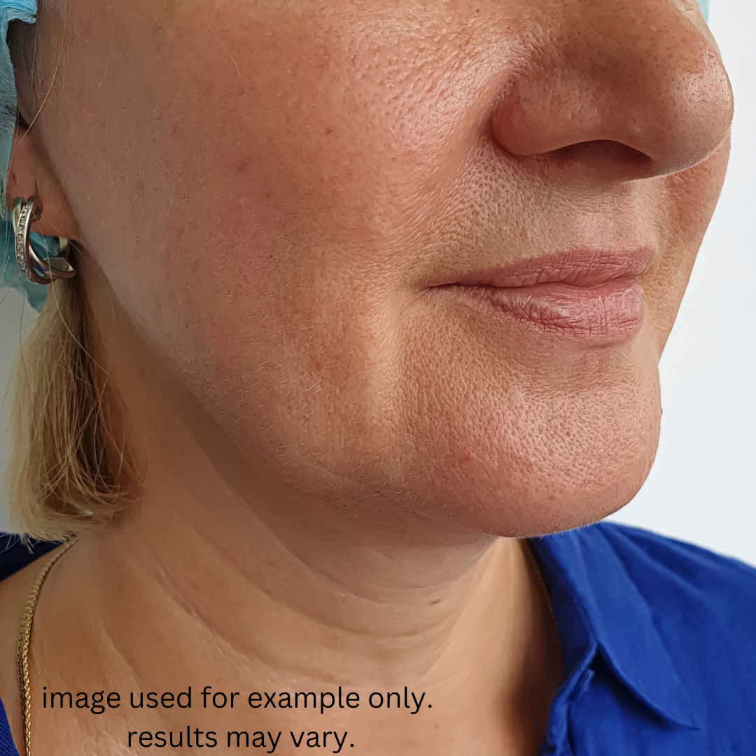 Lumen LED Radiance Therapy — Before