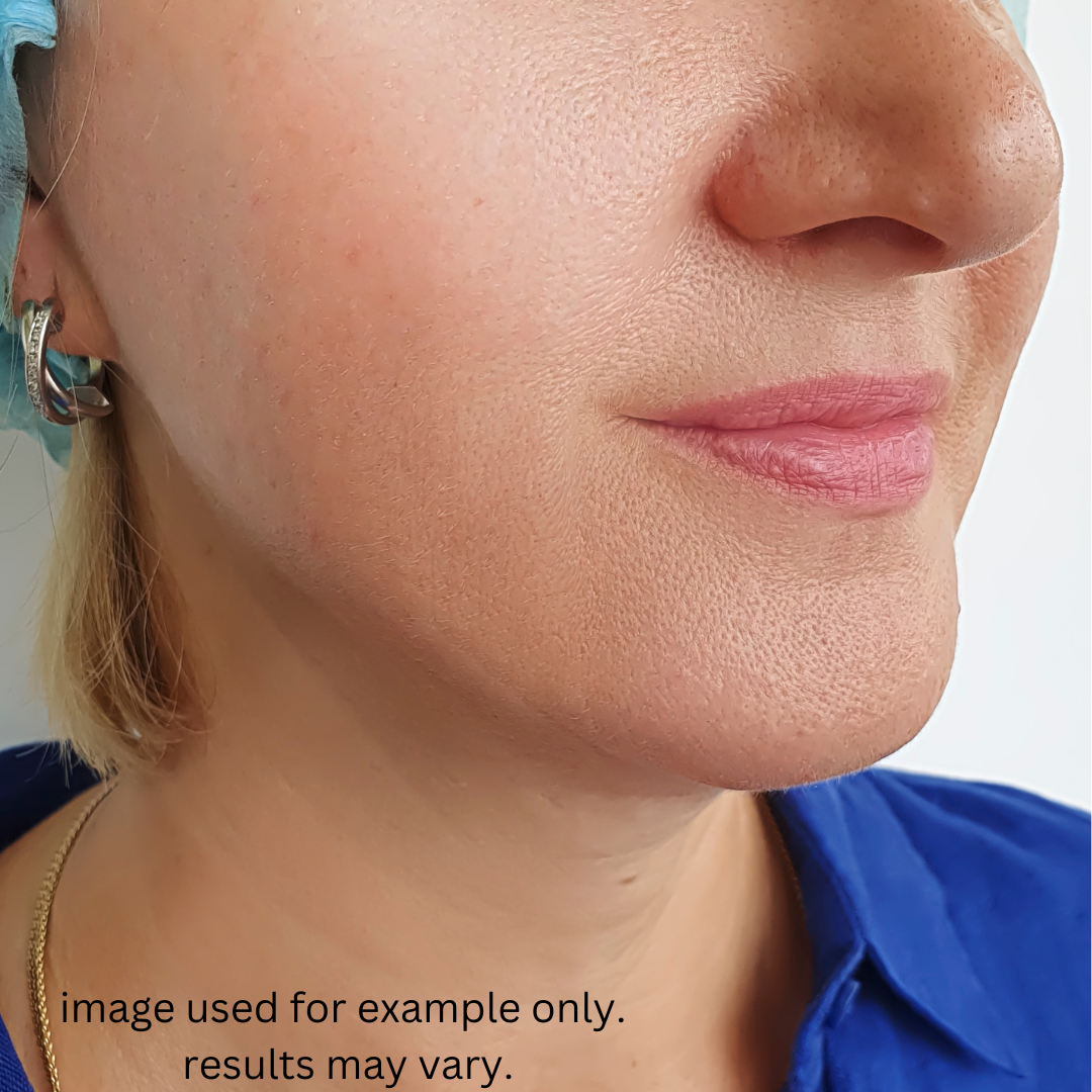 Firmness Appearance — after